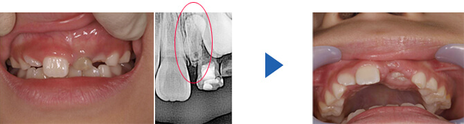 過剰歯の症例 